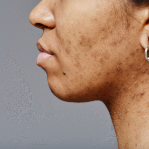 Pigmentation