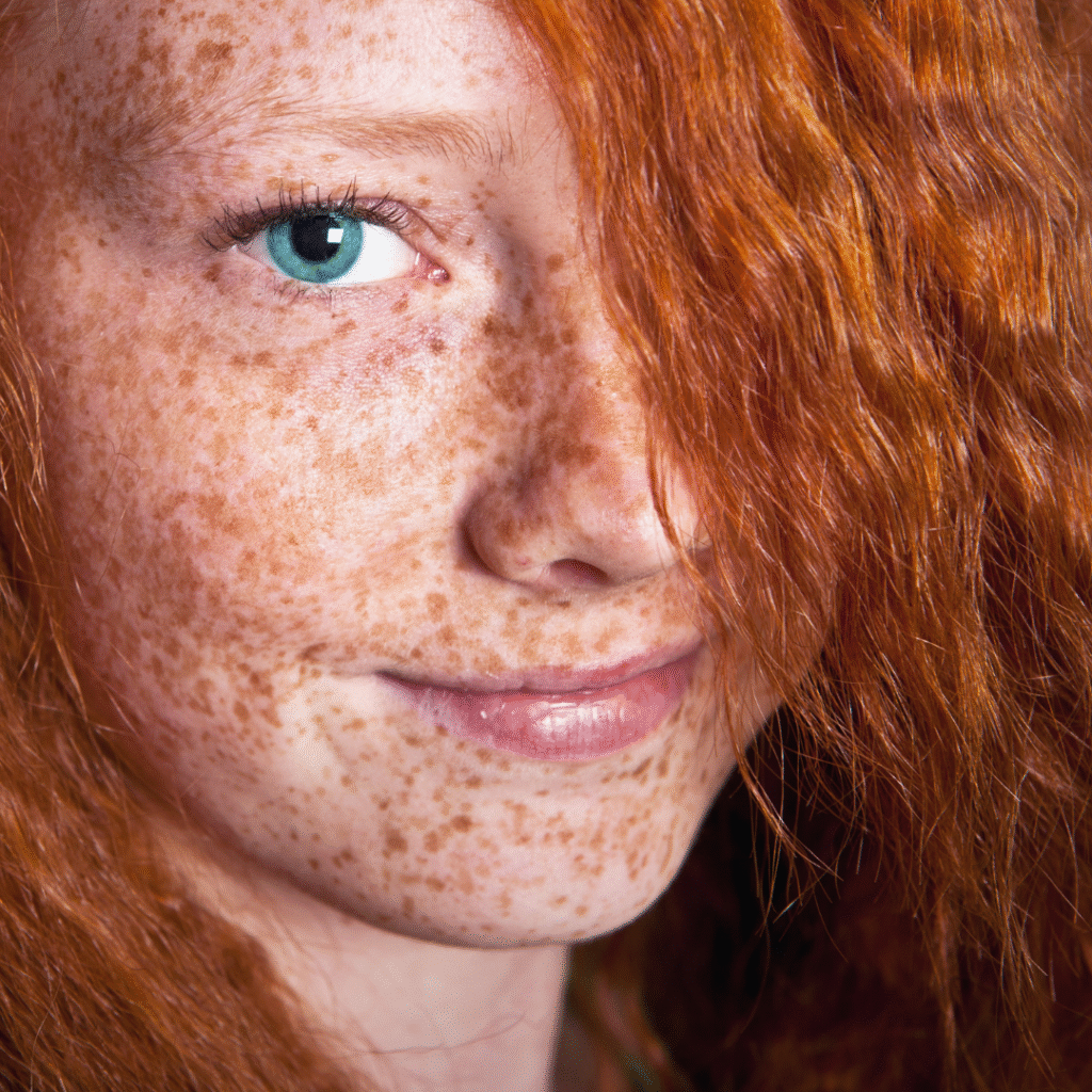 freckels