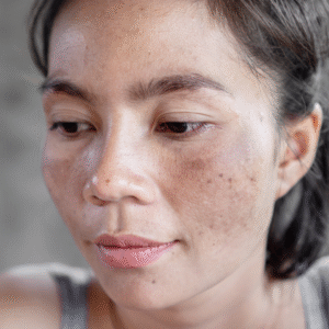 Melasma